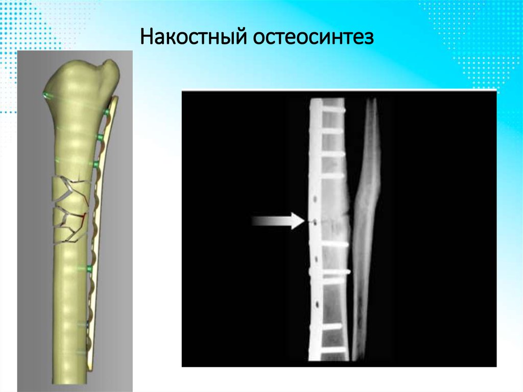 Переломы травматология презентация