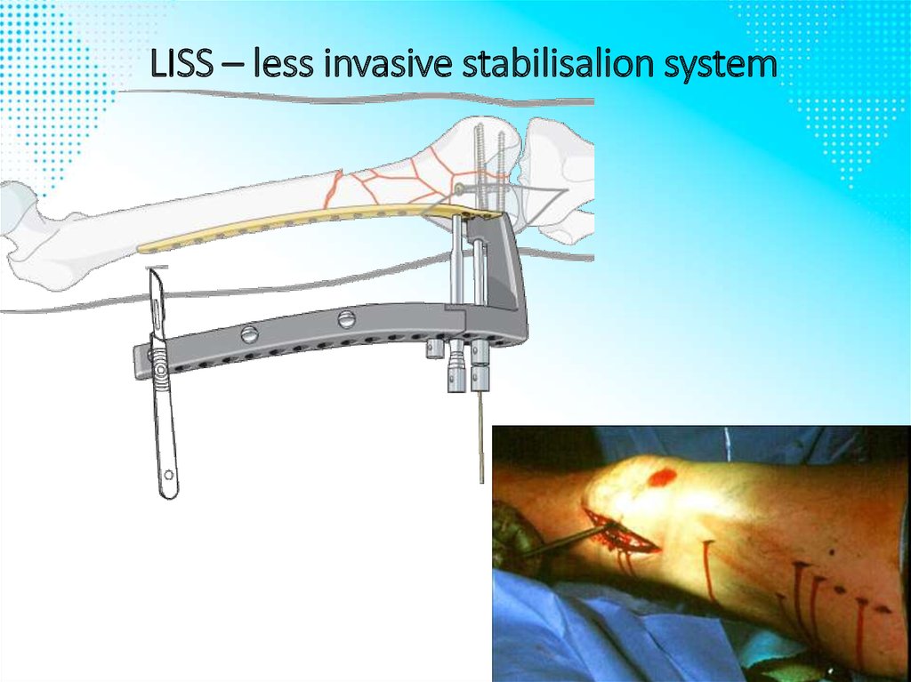 LISS – less invasive stabilisalion system