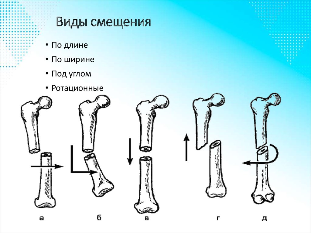 Смещение отломков кости. Смещение костных отломков при переломах. Поперечный перелом с вклинением отломков. Поперечный перелом со смещением отломков по ширине. Смещение отломков при переломе.