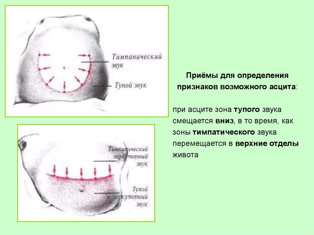 Признаки асцита. Перкуторный звук при асците. Методика определения асцита. Симптомы асцита при пальпации. Перкуссия живота асцит.