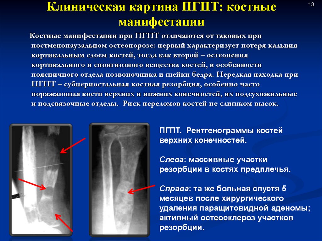 Резорбция кости