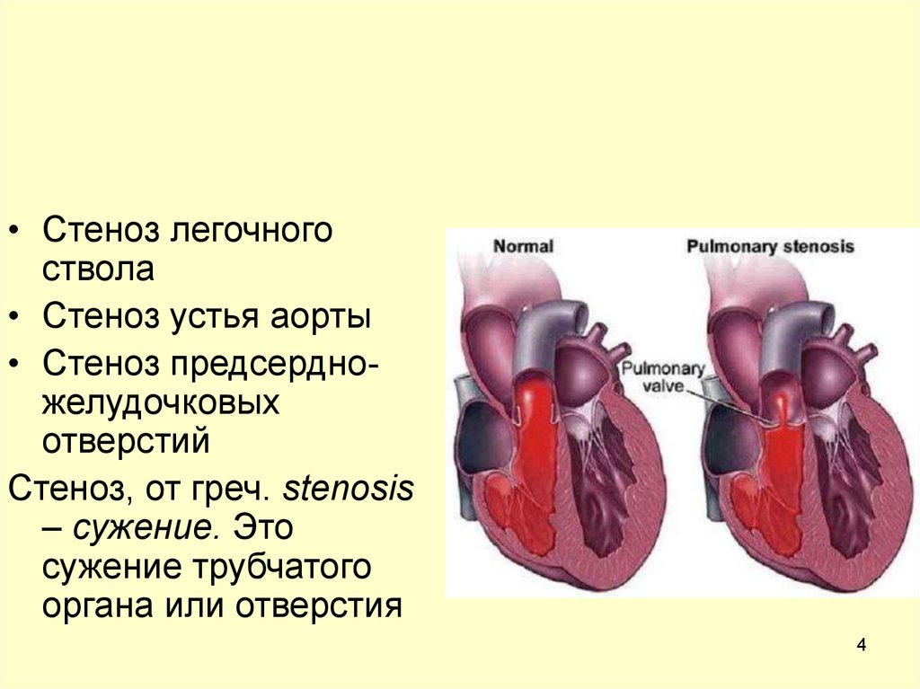 Легочный ствол анатомия. Стеноз устья легочного ствола. Сужение легочного ствола. Легочный ствол сердца. Сужение устья аорты; сужение устья легочной.