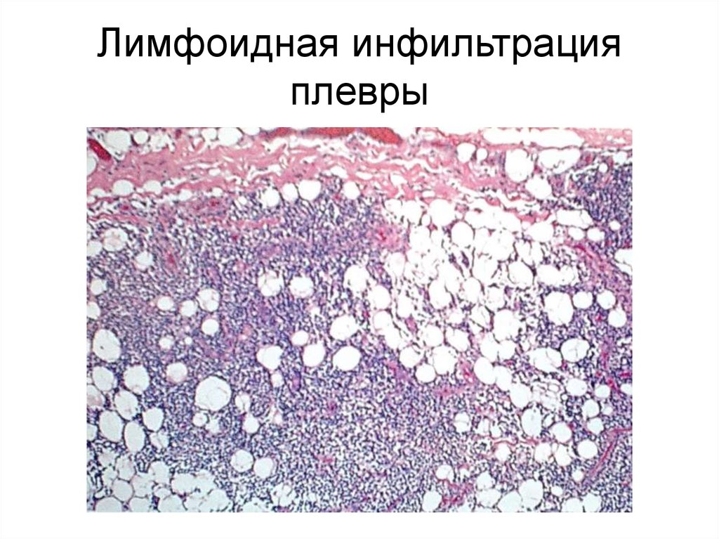 Лимфоидная инфильтрация гистология. Лимфоплазмоцитарная инфильтрация гистология. Лимфоидная перибронхиальная инфильтрация. Диффузная лимфоцитарная инфильтрация.