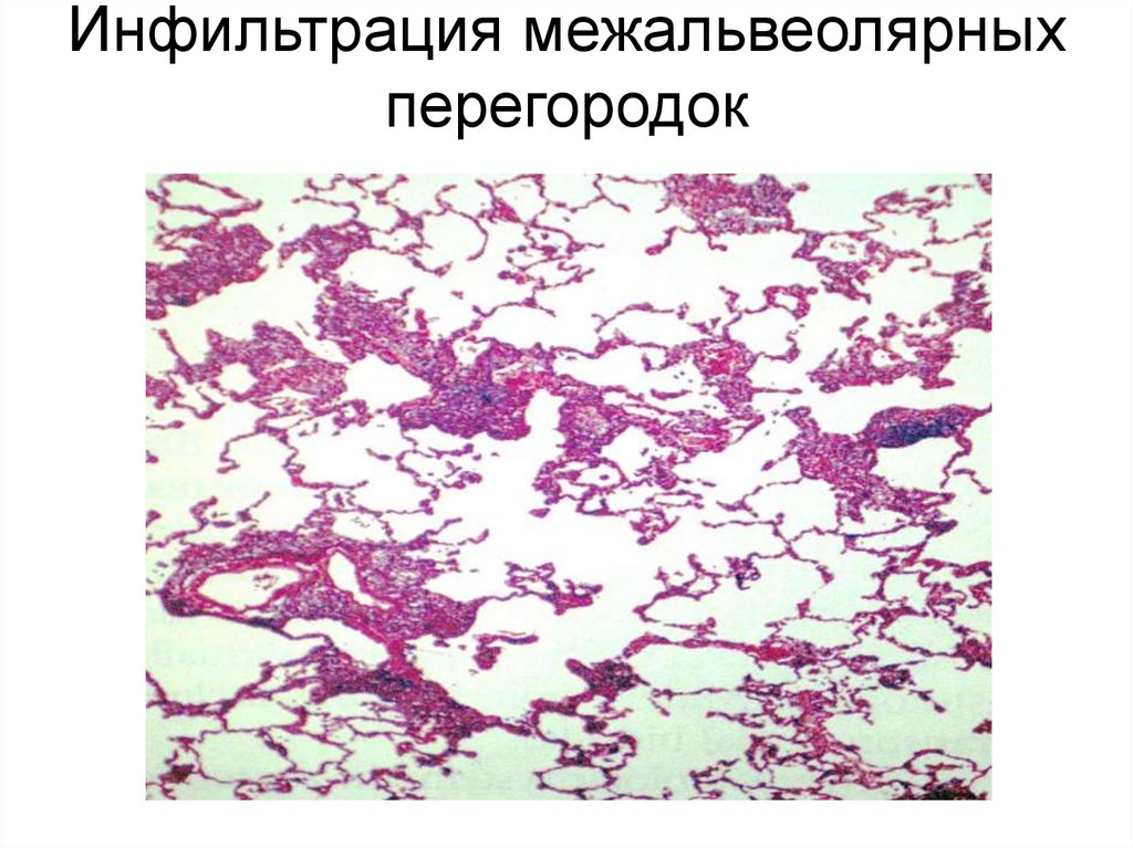 Инфильтрация межальвеолярных перегородок