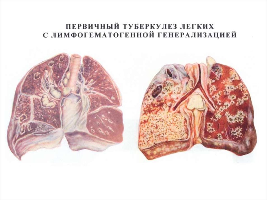 Осложнения туберкулеза картинки