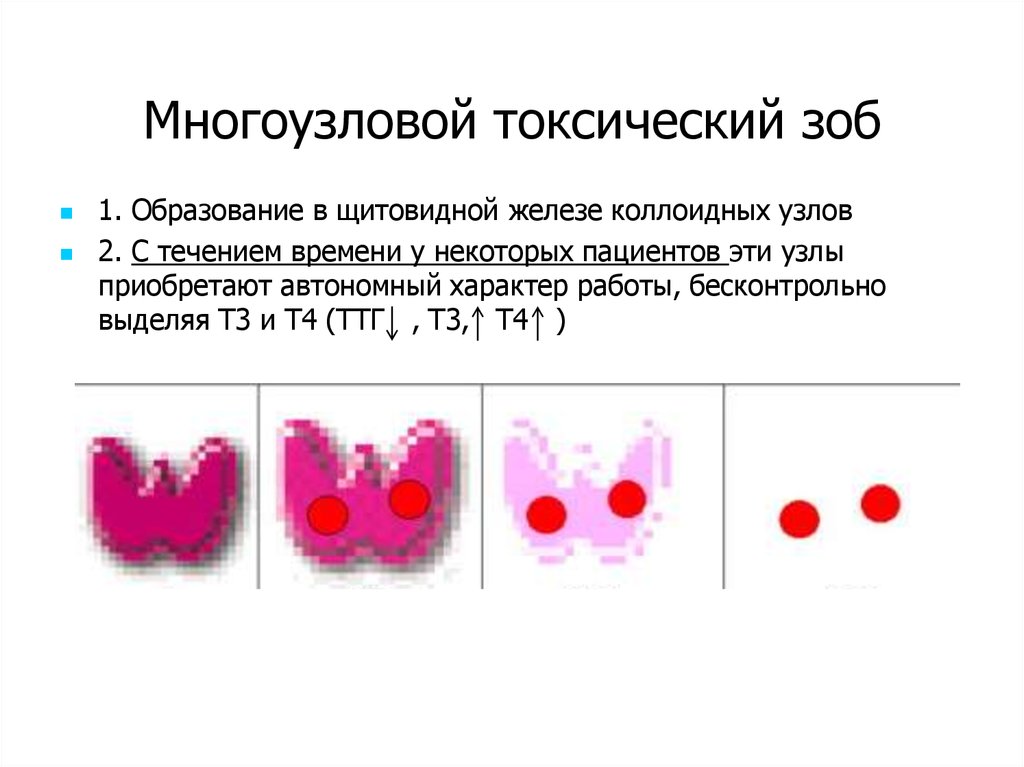 Гиперплазия щитовидной железы что это такое. Коллоидный зоб гистология. Щитовидка Узловой зоб лекарство. Многоузловой токсический зоб клиника. Узловой нетоксический зоб классификация.