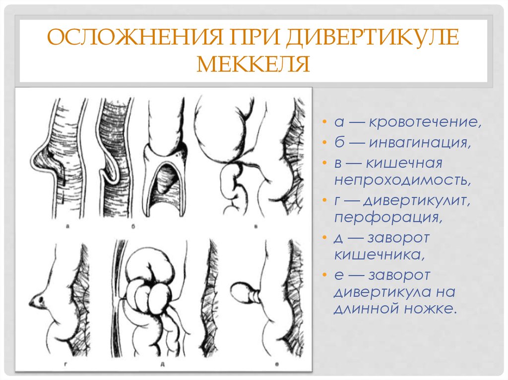 Дивертикул осложнения