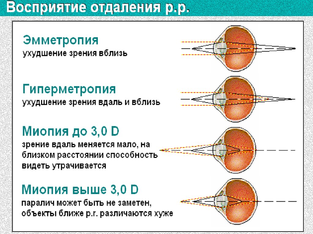 Соразмерная рефракция. Острота зрения. Рефракция. Аккомодация.. 11. Острота зрения. Рефракция. Аккомодация.. Изменения при аккомодации таблица. Аккомодация при миопии и гиперметропии.