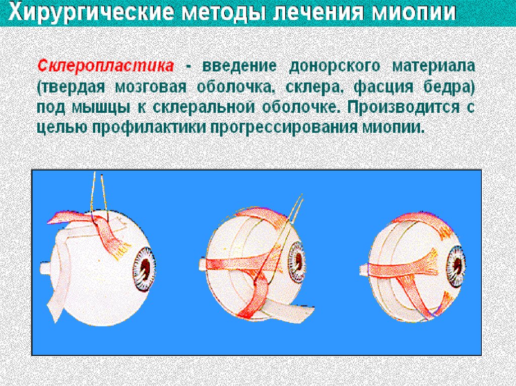 Операция миопия глаза. Операция склеропластика.