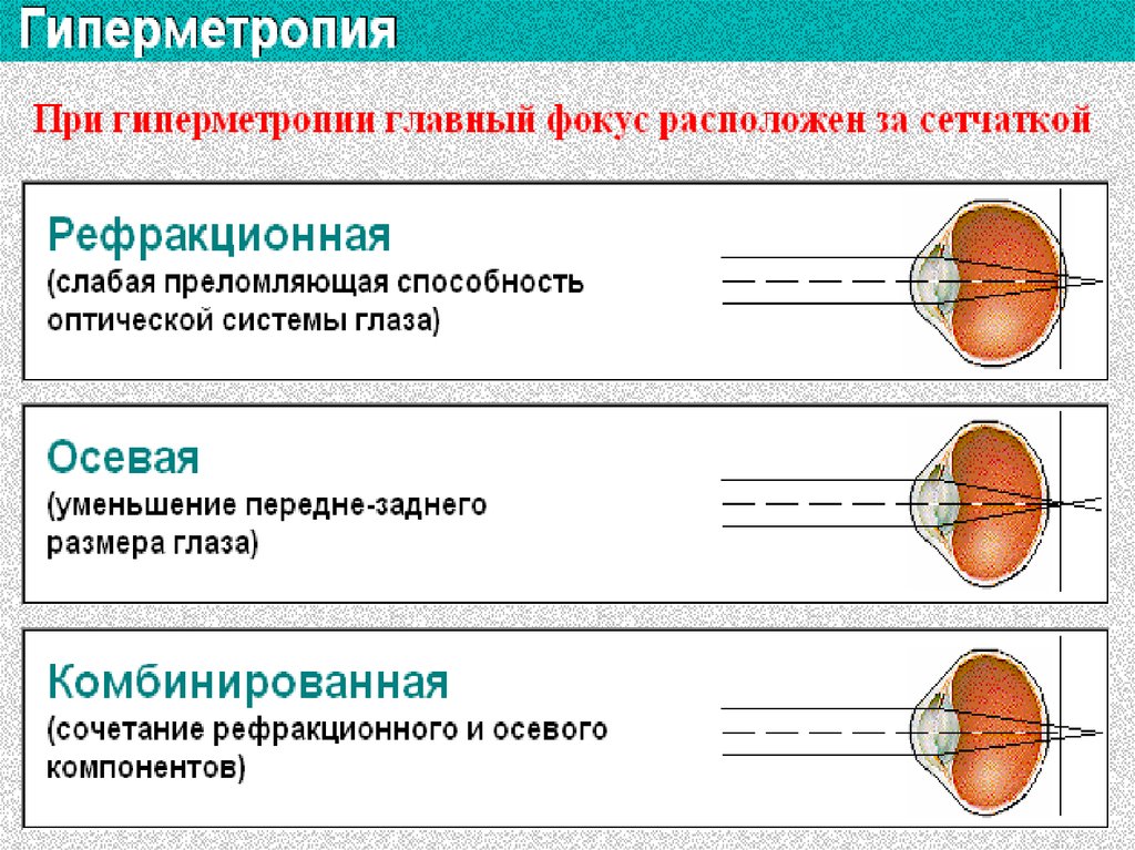 Гиперметропия 1 степени глаз. Острота зрения. Рефракция. Аккомодация.. Состояние аккомодации фокус таблица. Эмметропия гиперметропия миопия астигматизм. Состояния аккомодации глаза таблица.