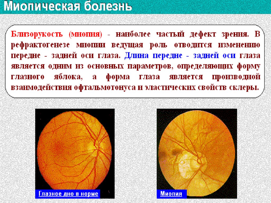 Рефракция глаза презентация