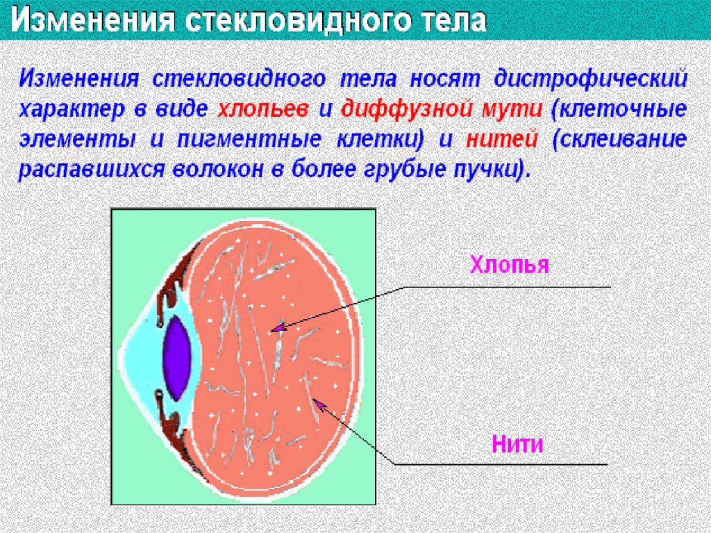 Нарушение аккомодации это дистрофия.