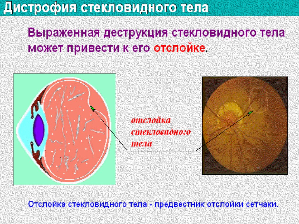 Аккомодация офтальмология презентация