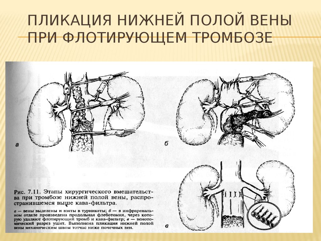 Нижней полой. Клипирование нижней полой вены это. Пликация нижней полой вены операция.