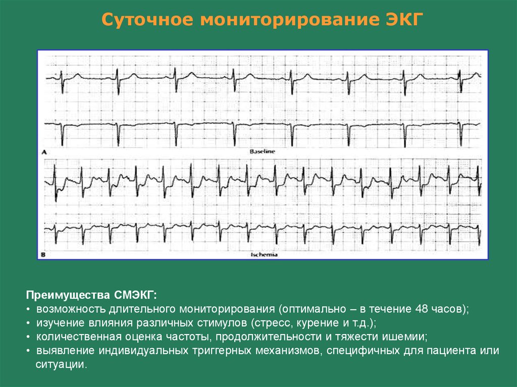 Ишемия сердца на экг фото