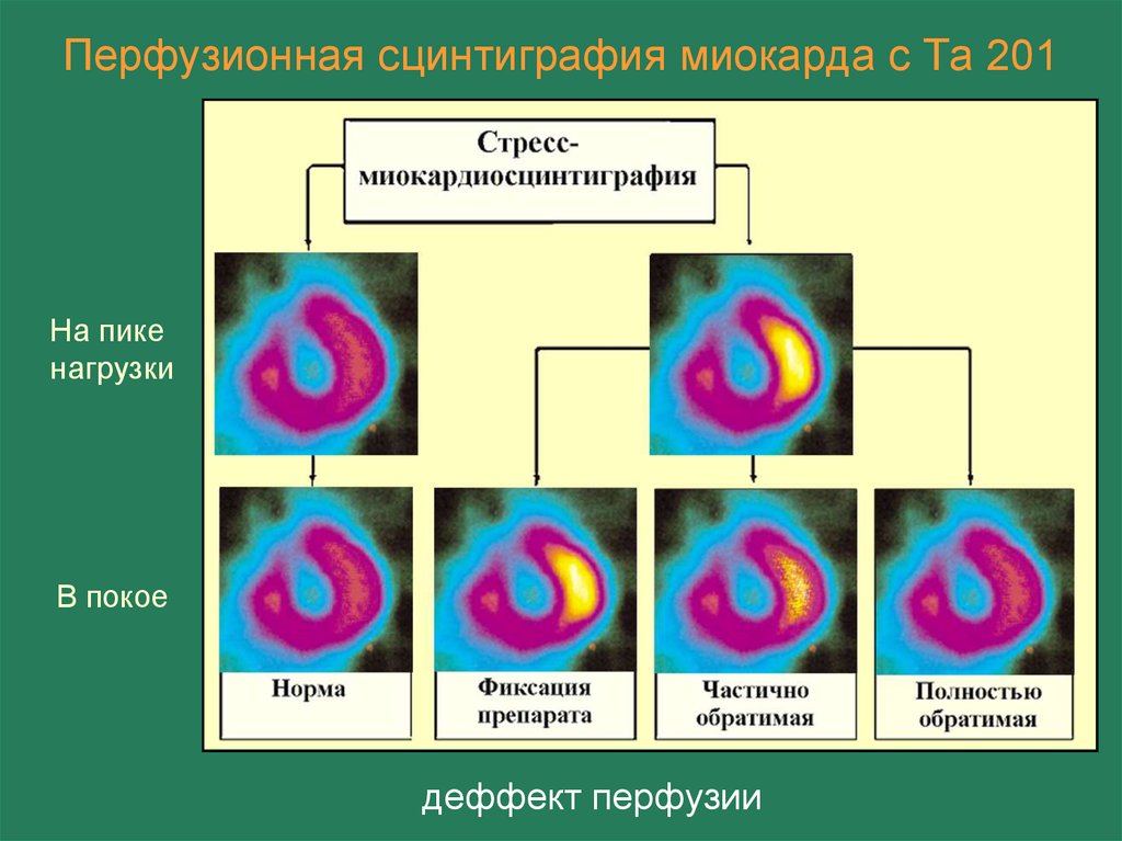 Презентация сцинтиграфия миокарда