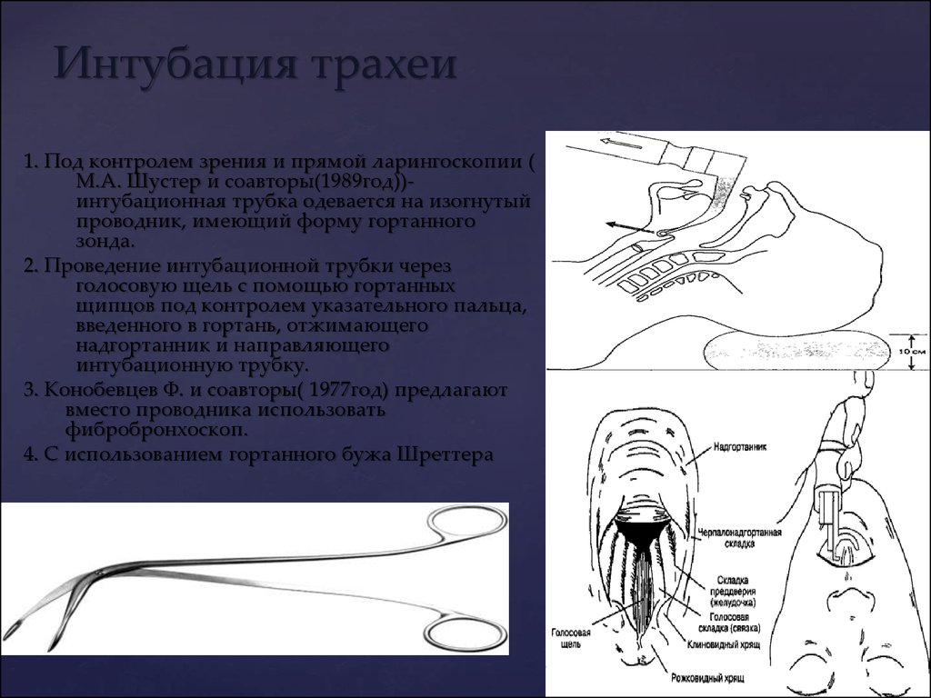 Трахея имеет форму трубки длиной 9. Интубация трахеи методом прямой ларингоскопии. Трубка для интубации трахеи. Контроль. Интубации трахеи. Интубация с разрезом трахеи.