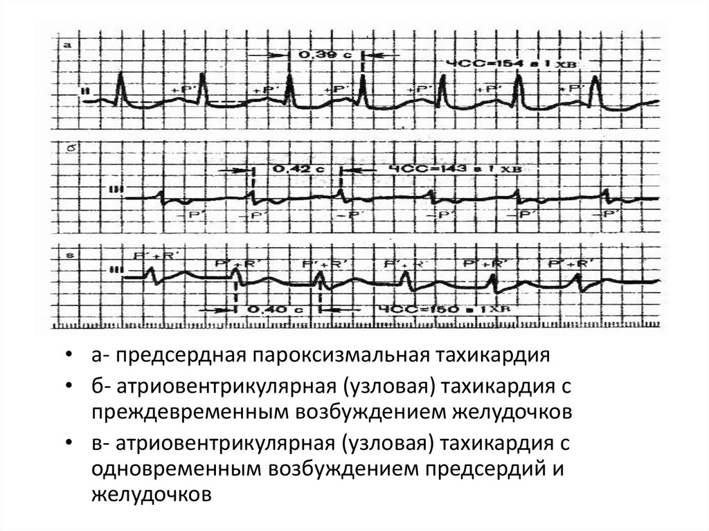 Предсердная тахикардия. ЭКГ при предсердной тахикардии. Предсердная пароксизмальная тахикардия на ЭКГ. Предсердная тахикардия на ЭКГ признаки. ЭКГ при предсердной пароксизмальной тахикардии.