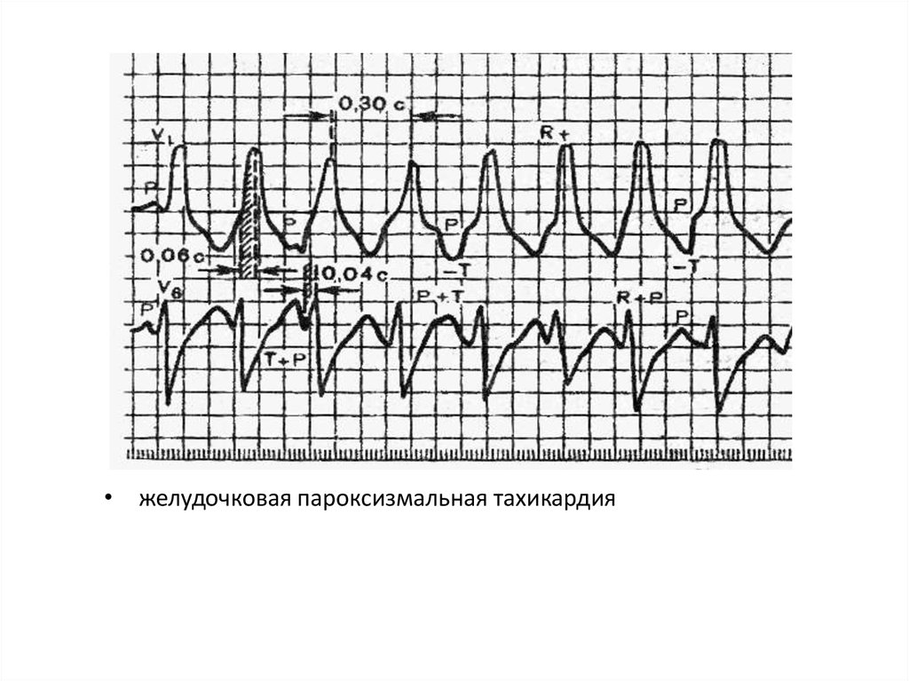 Желудочковая тахикардия. Пароксизмальная желудочковая тахикардия на ЭКГ. Пароксизм желудочковой тахикардии ЭКГ. Веретенообразная желудочковая тахикардия ЭКГ. ЭКГ при желудочковой пароксизмальной тахикардии.