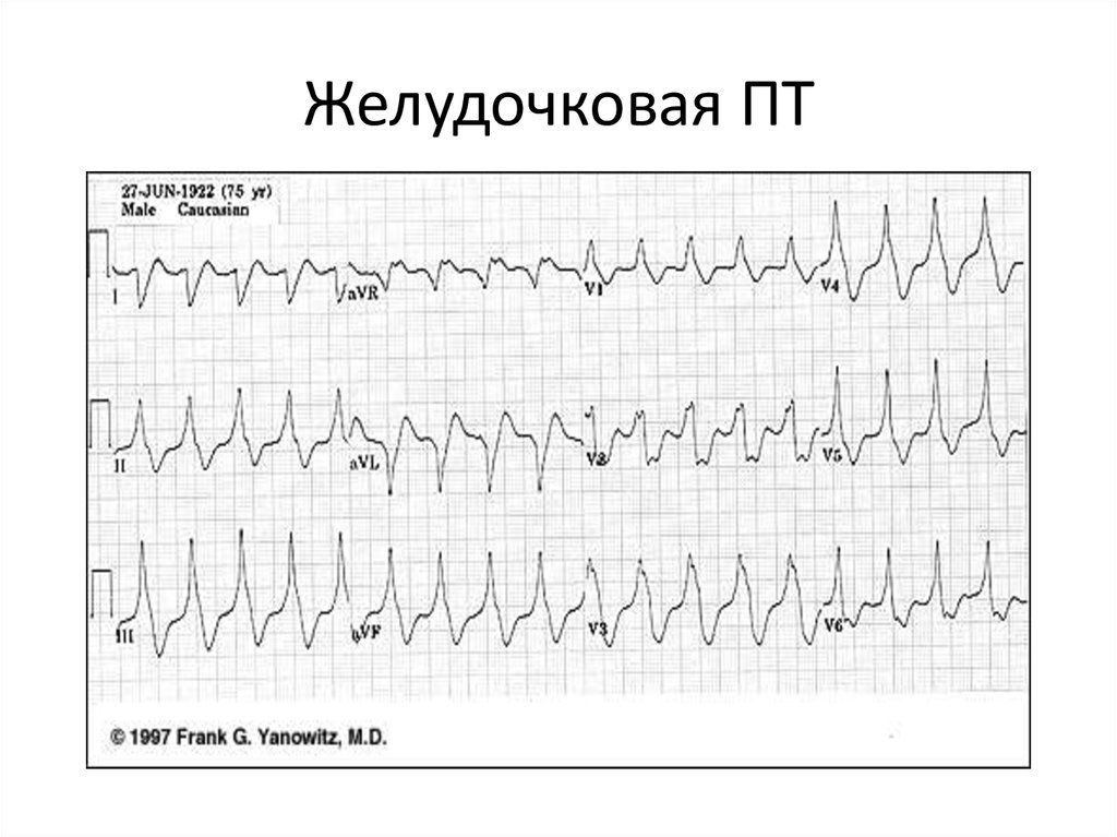 Желудочковая тахикардия карта вызова