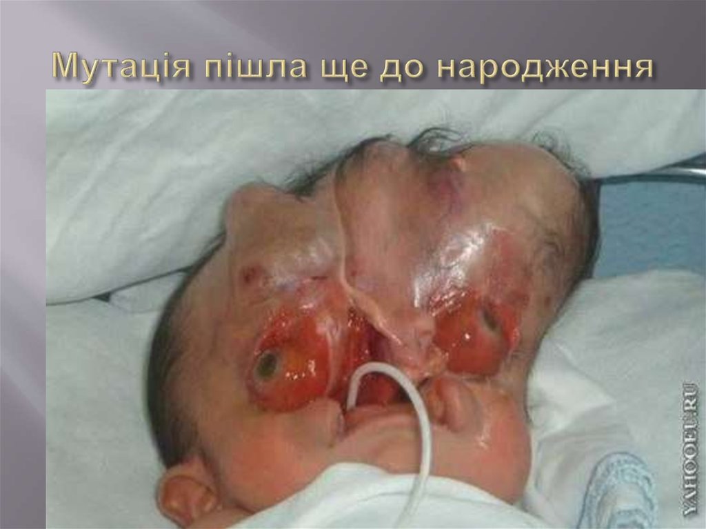 Мутація пішла ще до народження
