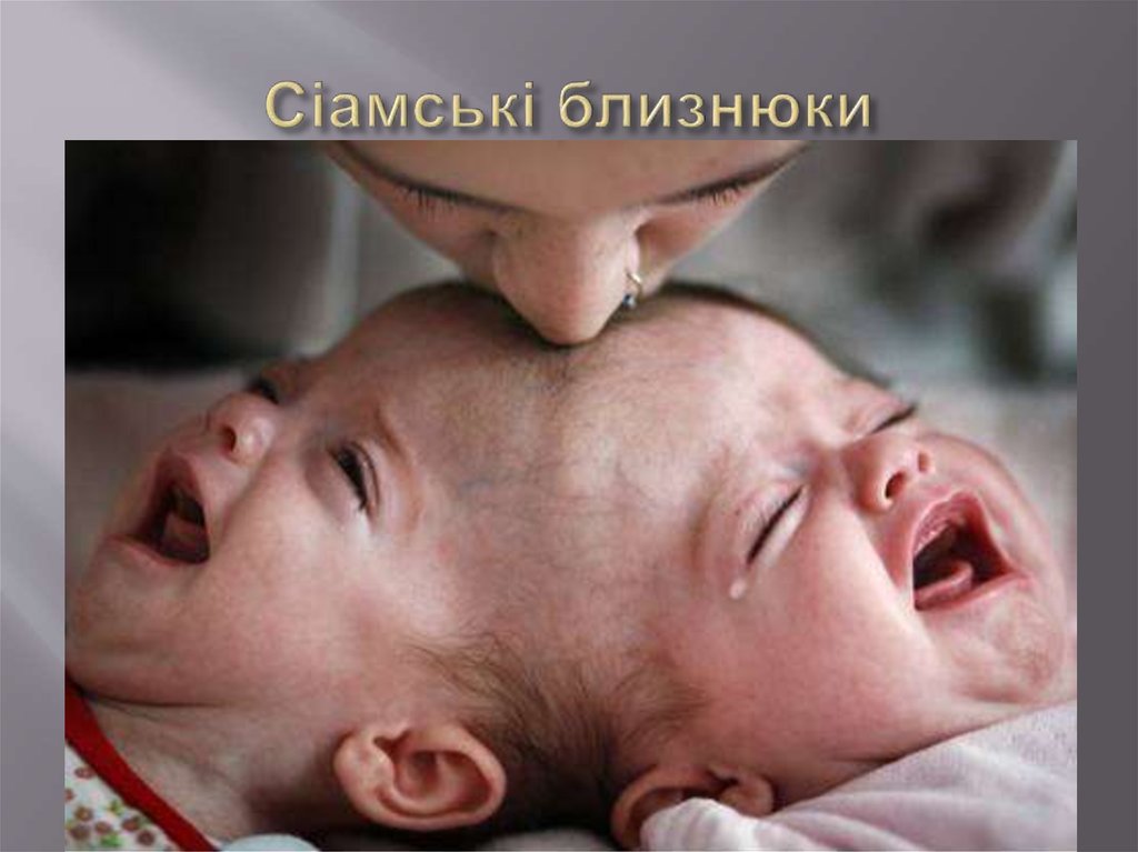 Сіамські близнюки