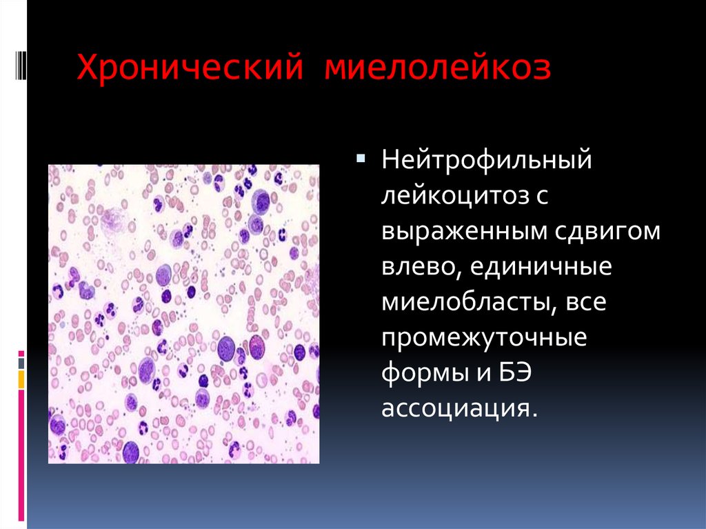 Нейтрофильный лейкоцитоз влево. Хронический миелолейкоз нейтрофильный. Хронический миелолейкоз этиология патанатомия. Хронический лейкоз миелолейкоз. Хронический миелобластный лейкоз гистология.