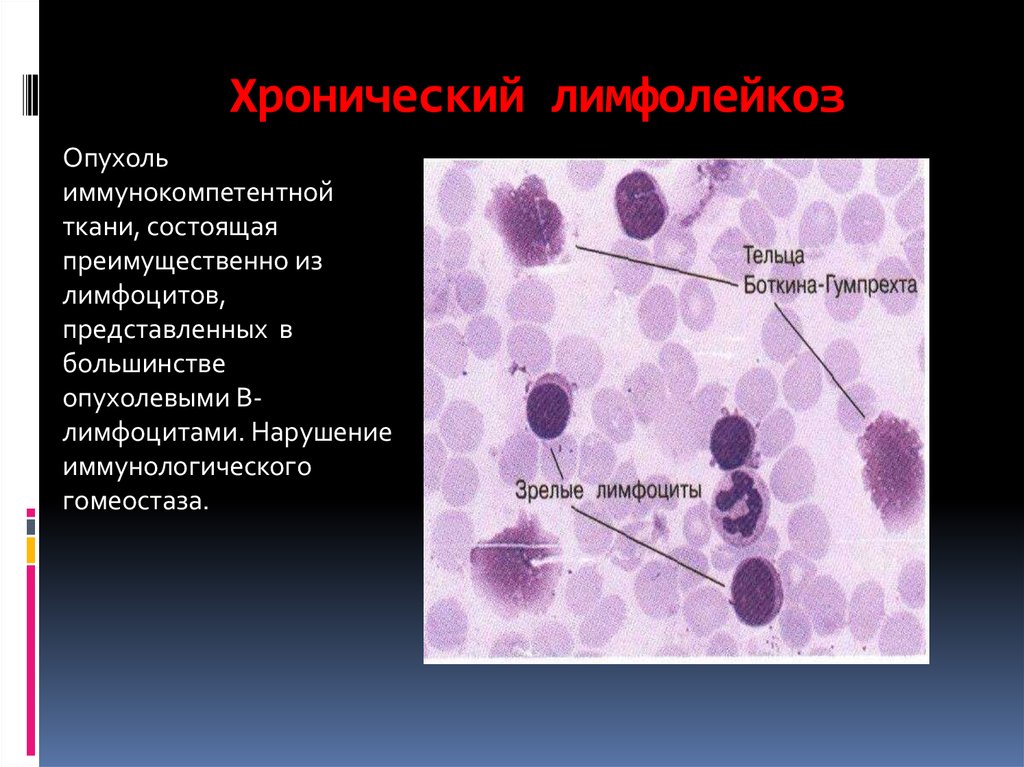 Как обозначаются лимфоциты в крови. Клетки Боткина Гумпрехта это. Острый лейкоз и хронический лимфолейкоз. Хронический лимфолейкоз микроскопия. Абсолютный в-лимфоцитоз при хроническом лимфолейкозе.