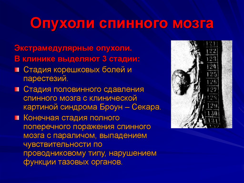 Конечная стадия. Стадии развития опухоли спинного мозга. Опухоль спинного мозга симптомы. Клинические проявления опухолей спинного мозга. Опухоли спинного мозга клиника.