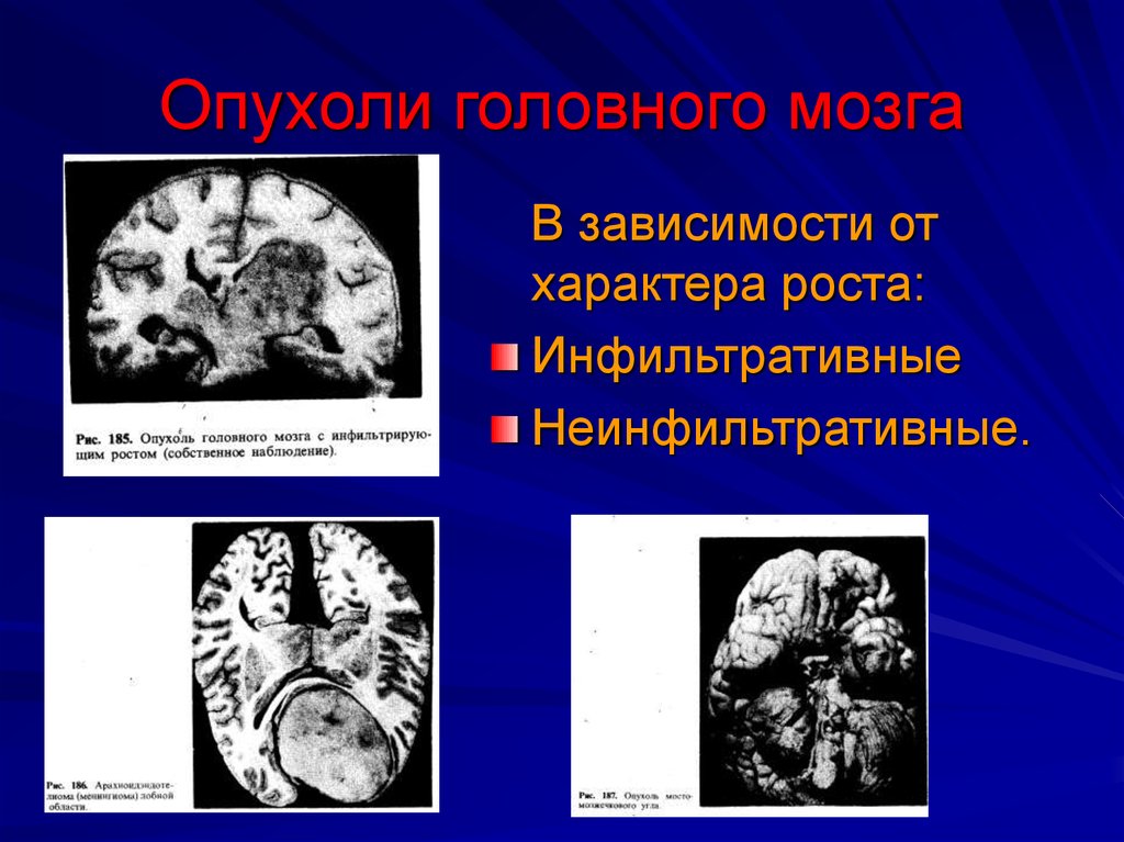 Опухоль мозга презентация