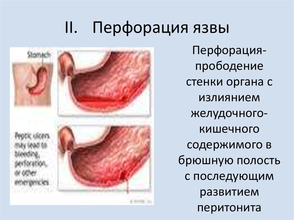 Перфорация язвы