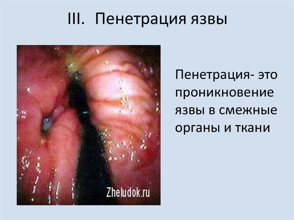 Пенетрация язвы