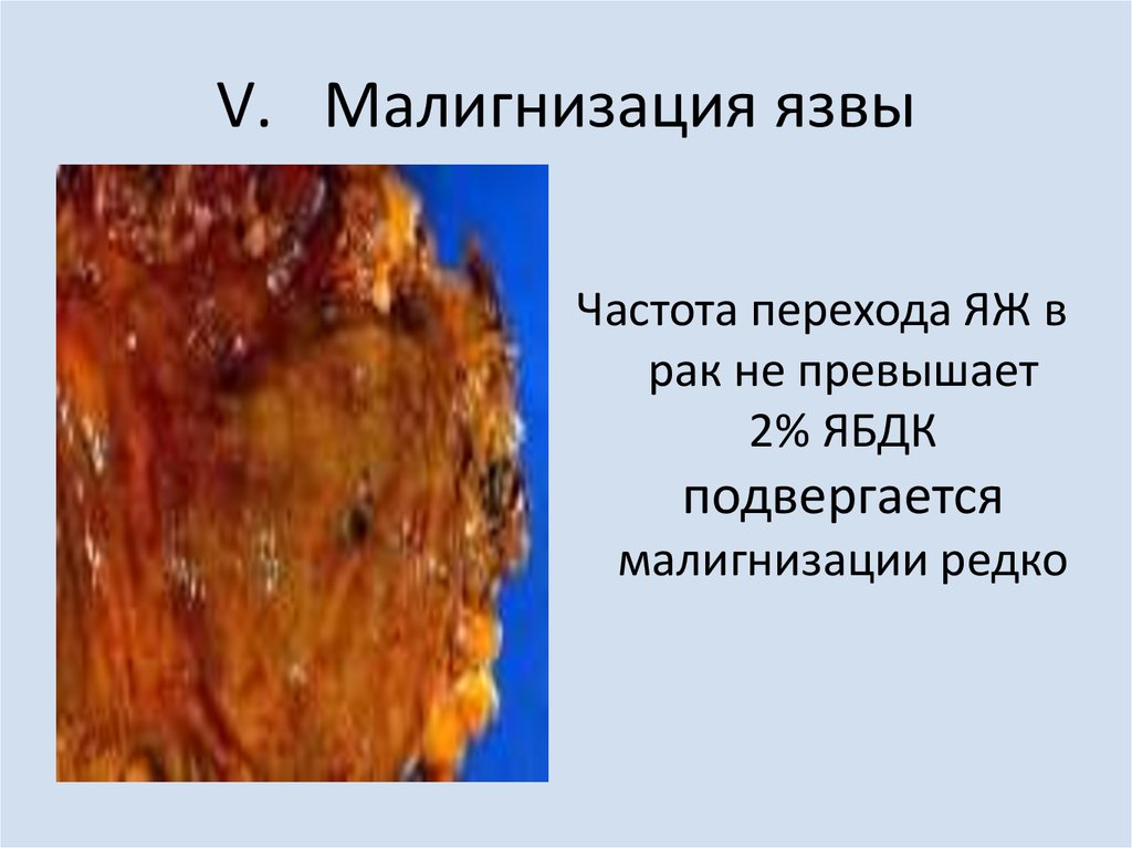 Малигнизация язвы