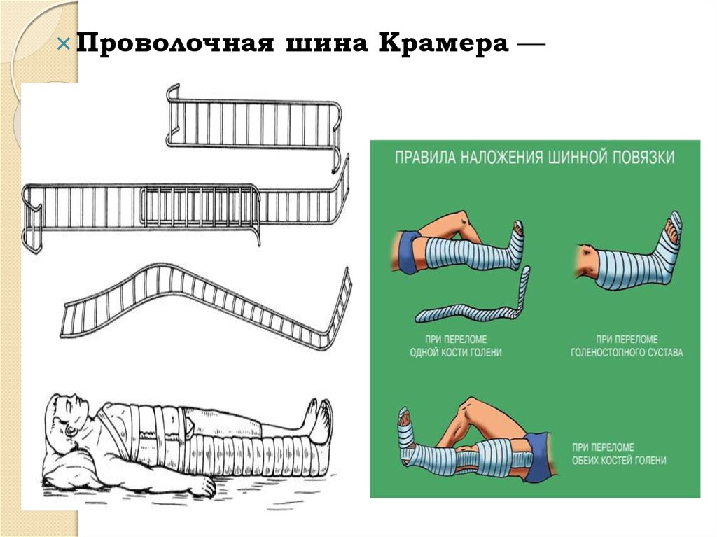 Современные средства транспортной иммобилизации