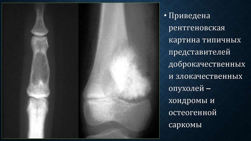 Злокачественные опухоли костей презентация