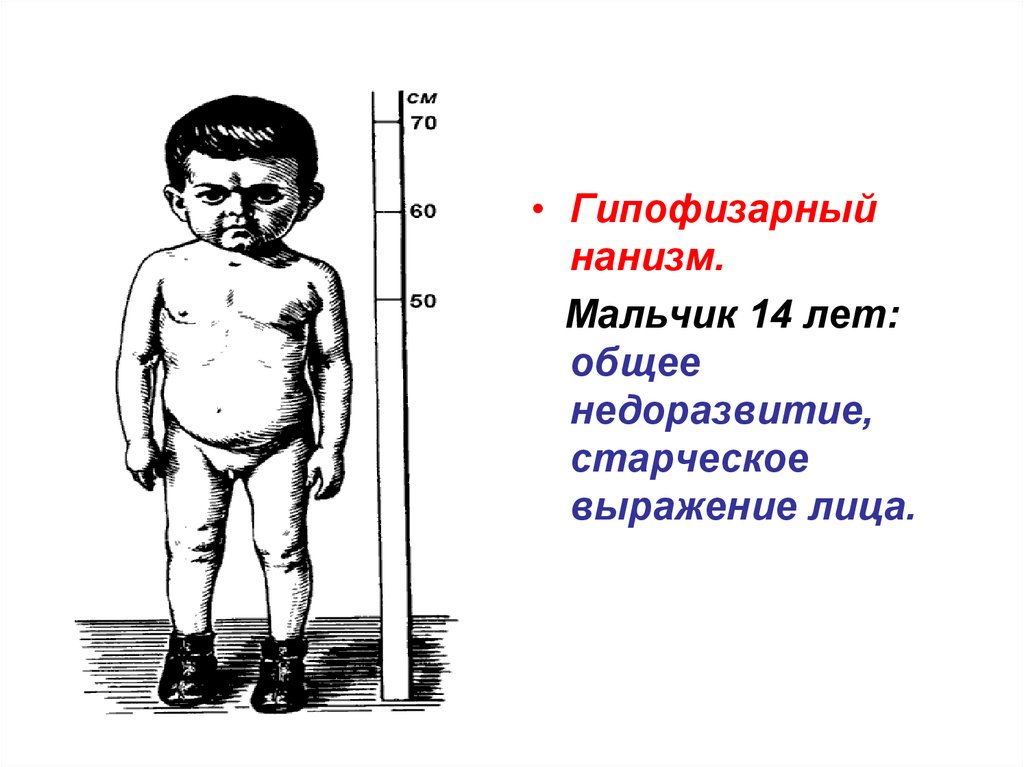 Как называется карликовость. Заболевания гипофиза карликовость. Гипокортикоидная карликовость. Гипофизарный карликовый нанизм. Гипофизарный нанизм клиническая картина.