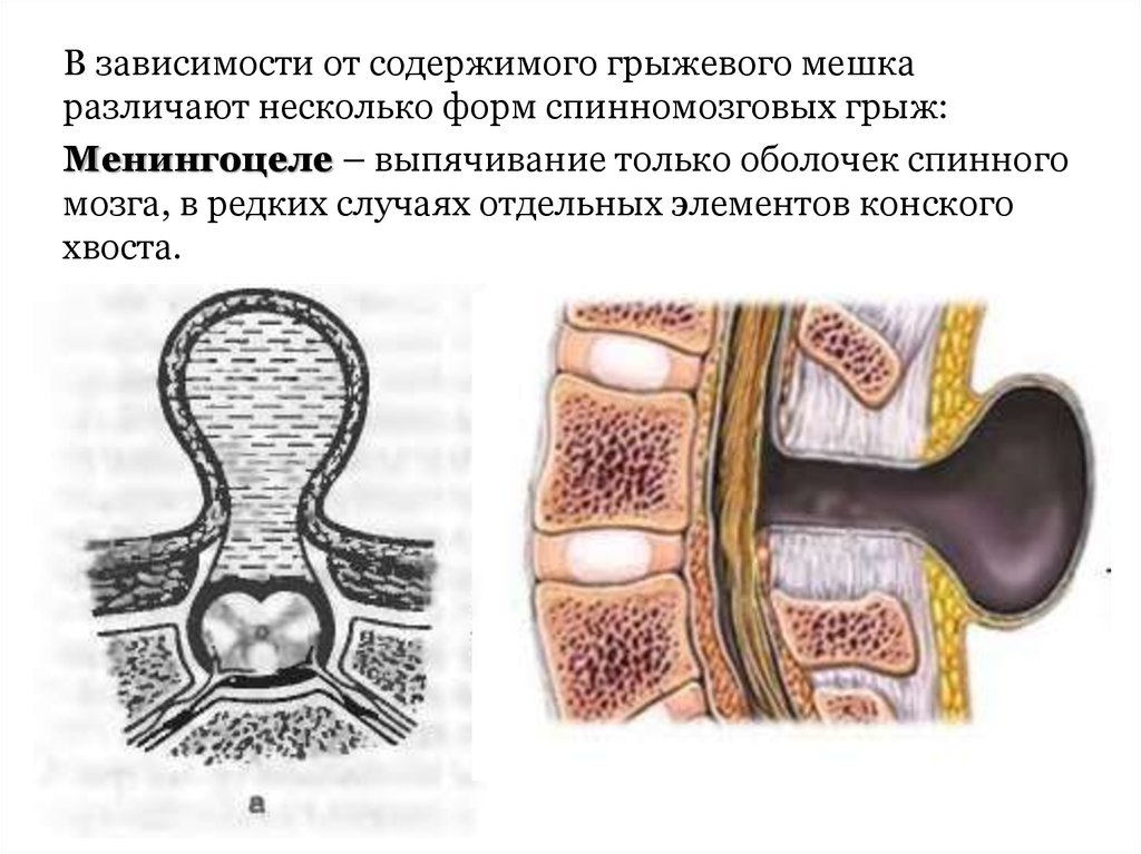 Расщепление позвоночника презентация