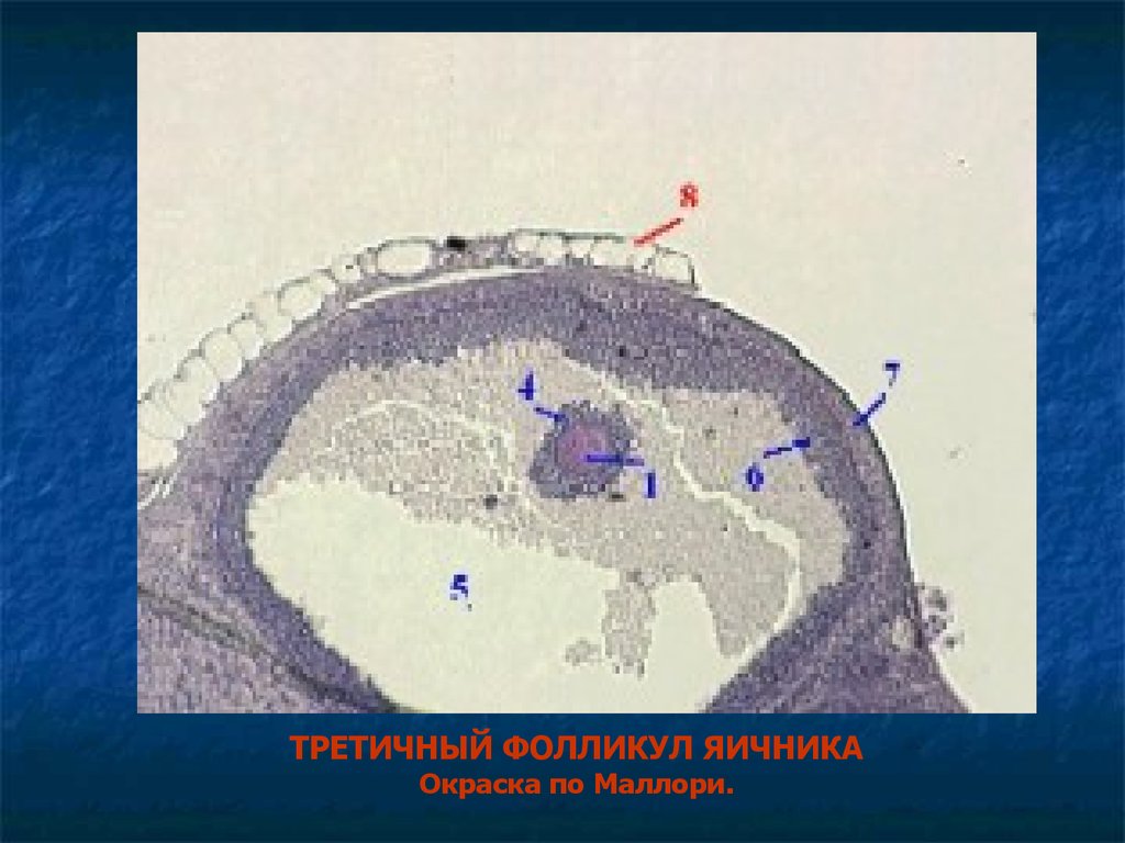 Фолликулы в глазах. Третичный фолликул. Третичный фолликул яичника. Третичные отложения.