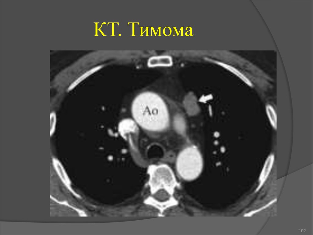 Тимома кт картина