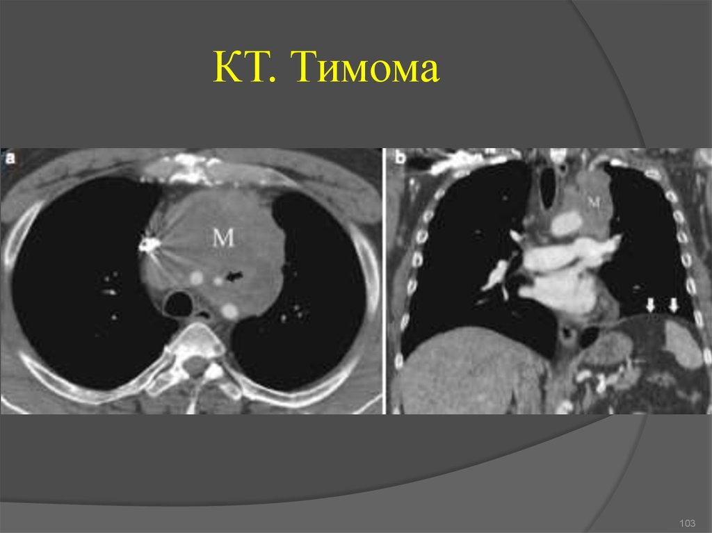 Тимома кт картина