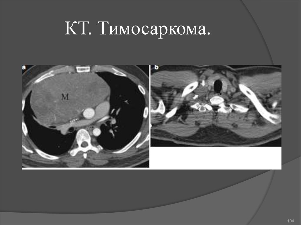 Примеры диагноза тимома.