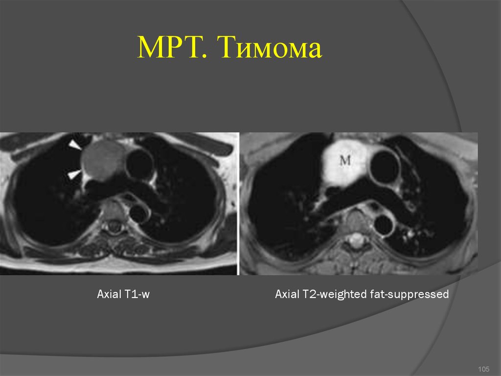 Тимома. Тимома средостения мрт. Злокачественная тимома кт.