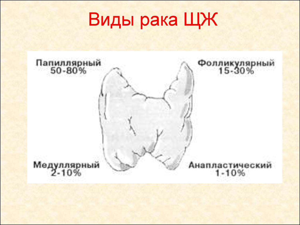 Формы рака щитовидной железы