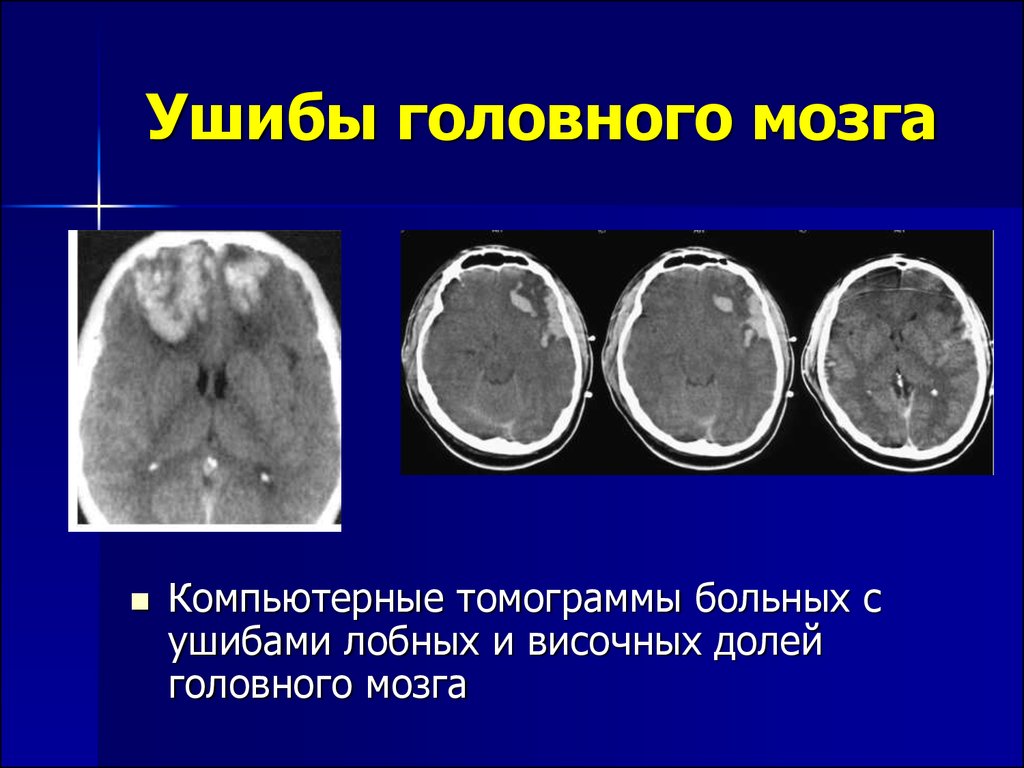 Сотрясение 4. Черепно мозговая травма кт и мрт. Ушиб головного мозга средней степени кт. Ушиб головного мозга кт мрт. Ушиб головного мозга на кт 4 типа.