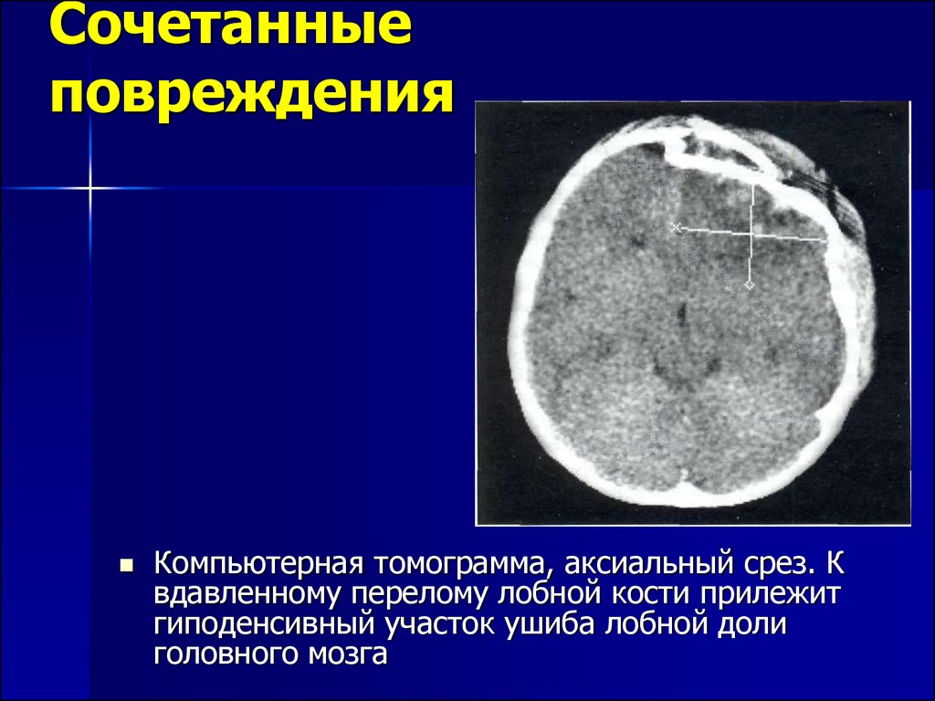 Сочетанные травмы карта вызова