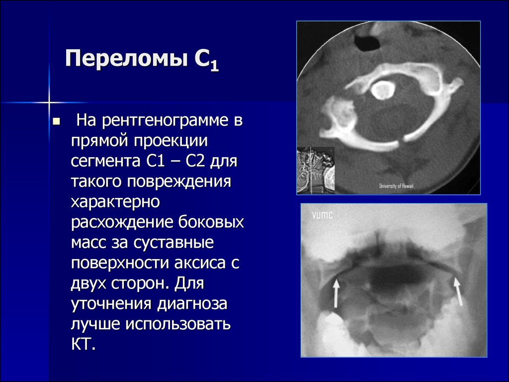 Черепно мозговые травмы и травмы позвоночника