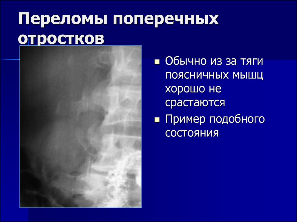 Поперечный перелом. Перелом поперечных отростков l1 l2. Перелом поперечного отростка l2. Перелом поперечного отростка l2 справа. Переломы поперечных отростков l3-l-5.