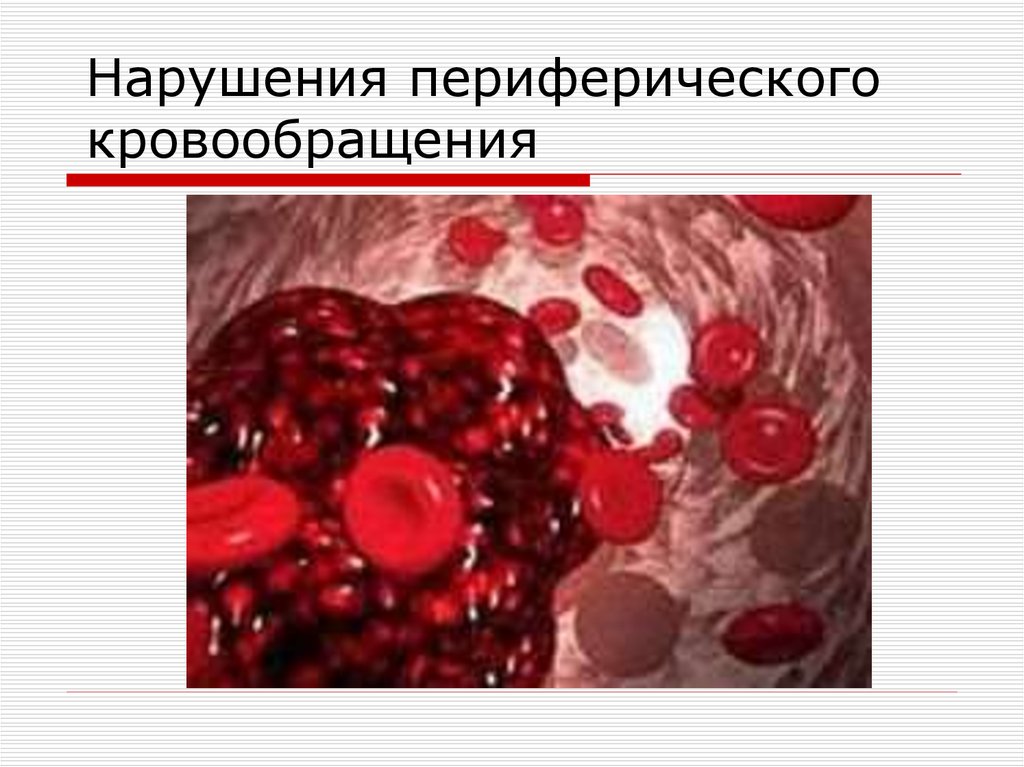 Лечение нарушений периферического кровообращения. Нарушение периферического кровообращения. Нарушение периферического кровообращения патология. Нарушение периферического кровообращения презентация. Нарушение микроциркуляции.