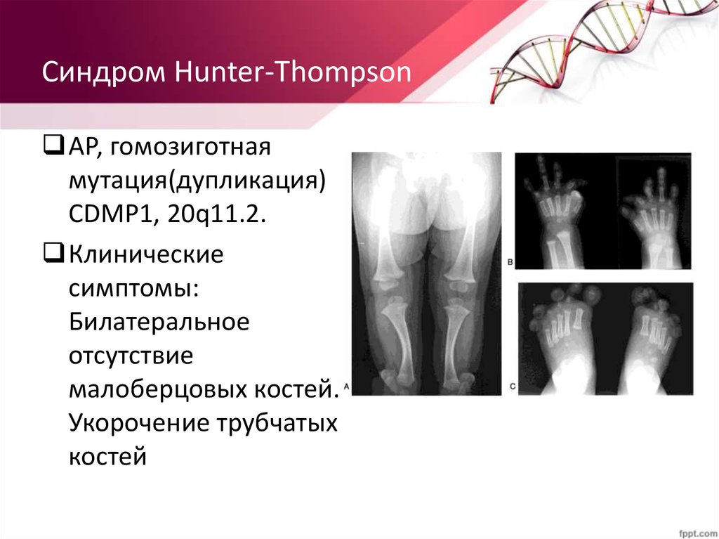 Симптом томпсона. Укорочение трубчатых костей. Синдром укорочения трубчатых костей. Укорочение длинных трубчатых костей.