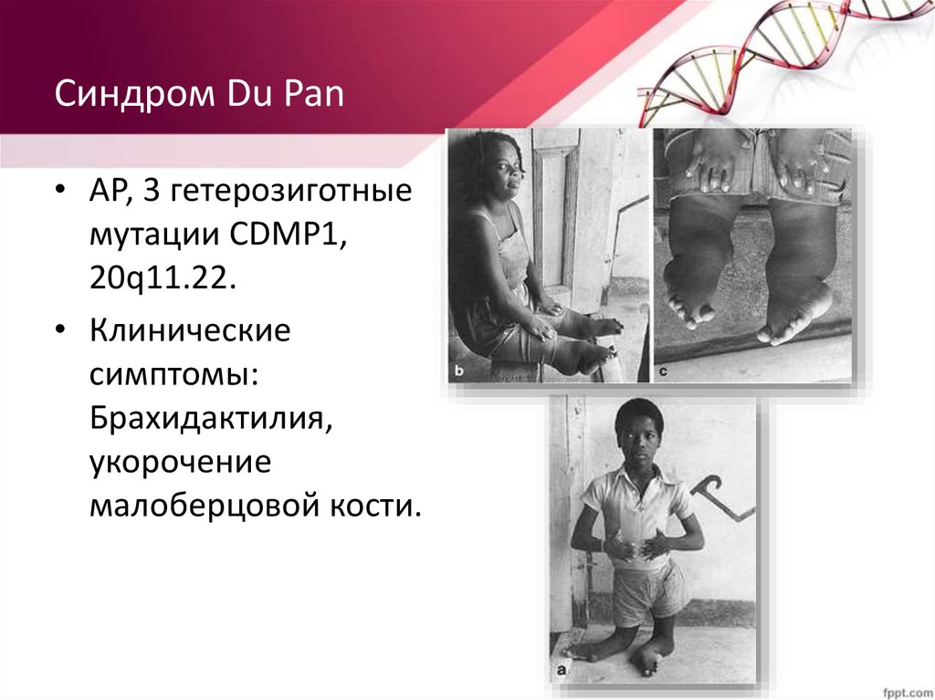 Синдром Du Pan